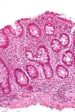 Micrograph showing intestinal crypt branching, a histopathological finding of chronic colitides. H&E stain.