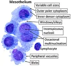 Cytology of the normal mesothelial cells that line the peritoneum, with typical features. Wright's stain
