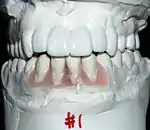 Sometimes the final position and restoration of the teeth will be simulated on plaster models to help determine the number and position of implants needed.