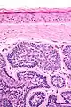 Micrograph of dermal cylindroma in H&E stain.