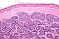 Micrograph of a dermal cylindroma in H&E stain.