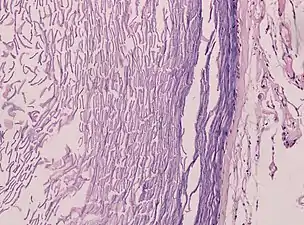 Histopathology showing epithelium and lamellated keratin (left)