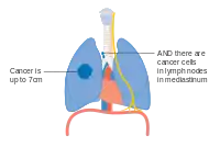 Stage IIIA lung cancer