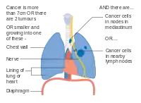 Stage IIIA lung cancer, if there is one feature from the list on each side