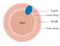 Dukes stage B bowel cancer; the cancer has invaded the muscle.