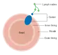 Dukes stage C bowel cancer; the cancer has invaded the nearby lymph nodes.