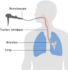 Diagram of a machine attached to a tube running down a person's mouth and into their trachea and bronchi