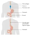 Diagram showing before and after a partial oesophagectomy