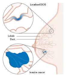 Diagram showing ductal carcinoma in situ (DCIS)