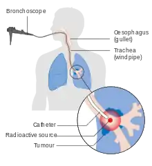 A machine attached to a tube that goes into a person's mouth and into a bronchus. At the end, an object emits radiation at a lung tumor.