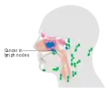 Maxillary sinus cancer that has spread to the lymph nodes