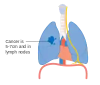 Stage IIB lung cancer