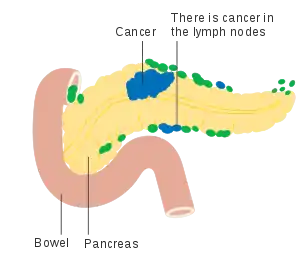 Involvement of nearby lymph nodes – Stage N1