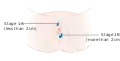 Stage 1A and 1B vulvar cancer