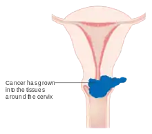 Stage 2B cervical cancer