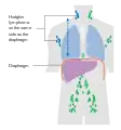 Stage 2 Hodgkin lymphoma