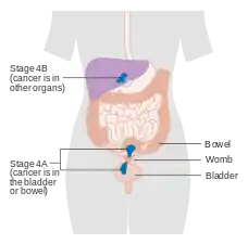 A diagram of stage IV endometrial cancer