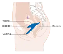 Stage 4A cervical cancer