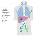 Stage 4 Hodgkin lymphoma