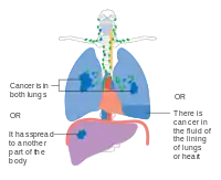 Stage IV lung cancer