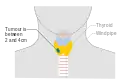 Stage T2 thyroid cancer