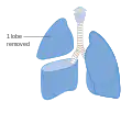 Removal of one lobe of the lung