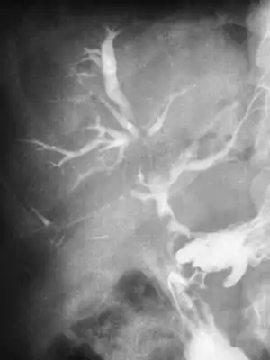 Image is an X-ray of Duodenobiliary fistula of biliary tree. It shows pipe like ulcers that result from the fistula.Barium demonstrates contrasts into the bile ducts.