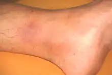 Dark area of skin, reminiscent of a bruise, on the inner ankle of an adult