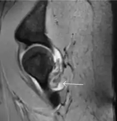 Sagittal T2* gradient echo image showing a posterior soft tissue mass with hypointense areas secondary to hemosiderin deposition.