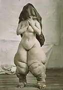 A striking example of objectification. Published as Bellevue Venus by  Oscar G. Mason, for depicting elephantiasis.