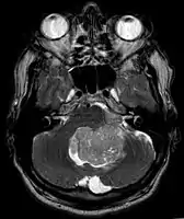 Ependymoma of 4.ventricle in MRI.