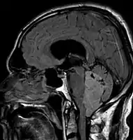 Ependymoma of 4.ventricle in MRI.