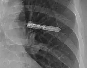 Implantable loop recorder