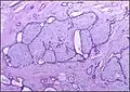 Histopathologic image of breast fibroadenoma showing proliferation of intralobular stroma compressing and distorting the epithelium. H&E stain.
