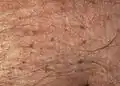 Pubic lice on the abdomen