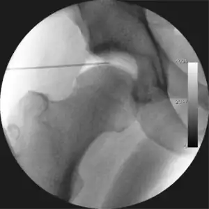 Figure 4. A needle is passed into the joint, breaking the 'suction seal', and allowing further distraction of the hip joint with minimal extra traction