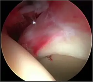 Figure 5. Portal placement under direct vision. The instrument is entering the joint through the hip capsule, between the femoral head (on the left) and acetabular labrum (on the right)