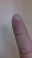 An incision: a small cut in a finger.