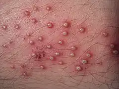 Folliculitis