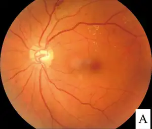 Photograph of retina after scatter laser surgery for diabetic retinopathy.