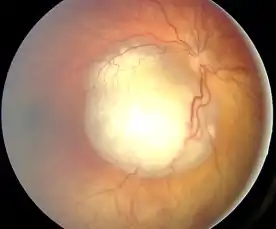 Ocular fundus aspect of retinoblastoma