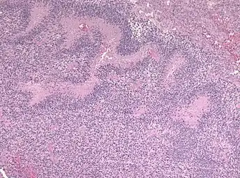 Pseudopalisading seen around necrosis in glioblastoma