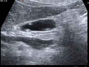 Ultrasound image of gallbladder polyps measuring 3–7 mm.