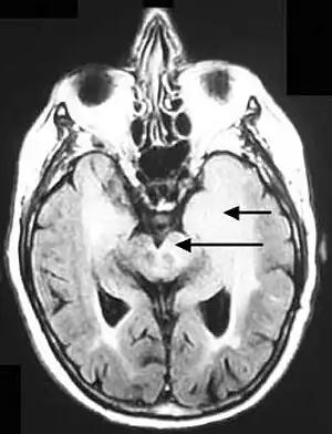 Axial fluid-attenuated inversion recovery MRI image demonstrating tumor-related infiltration involving both temporal lobes (Short arrow), and the substantia nigra (Long arrow).