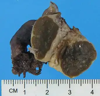 Typical gross pathology of a Leydig cell tumor (in this case of the ovary): A well circumscribed, solid homogeneous mass with golden brown to brownish green cut surface.