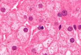 Micrograph showing ground glass hepatocytes. H&E stain.