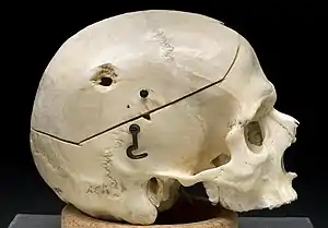 Skull, viewed from side, with hole on parietal bone from bullet exit