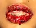 Inflammation and peeling of the lips—with sores presenting on the tongue and the mucous membranes in SJS