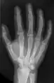 X-ray of the bones in the hand