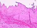 Histopathology of acute gangrenous cholecystitis, showing necrosis, neutrophils and partially sloughed off mucosa.